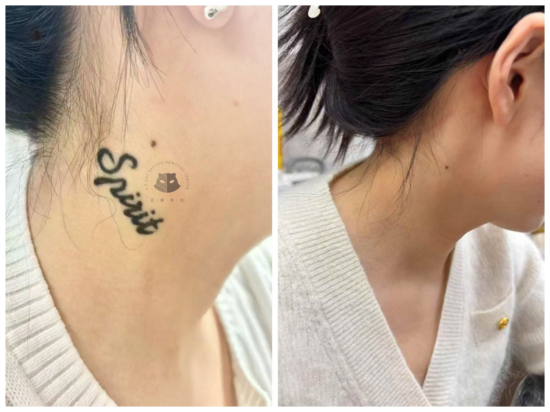 颈部黑色字母恢复原皮肤案例洗纹身前后对比效果图-专业激光清洗案例